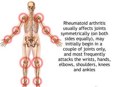 Arthritis Benefits